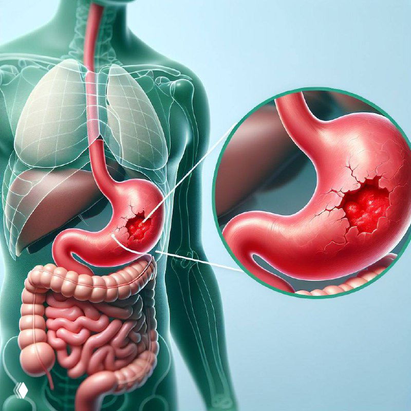Почему интервальное голодание вредно для ЖКТ