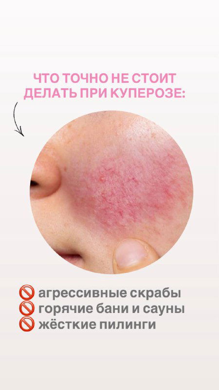 Круглая фотография воспалённой кожи щёки с выраженным покраснением — иллюстрация: чего не стоит делать при куперозе (агрессивные скрабы, сауны, жёсткие пилинги), на бежевом фоне.