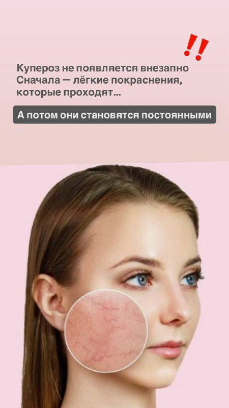 Портрет женщины с увеличенным кругом на щеке, демонстрирующим выраженный купероз и распределение капилляров; естественный макияж и мягкое студийное освещение для наглядности.