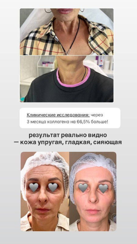 Коллаж «до и после» — фотографии лица и шеи, демонстрирующие предполагаемый визуальный эффект коллагеновой терапии и упругость кожи.