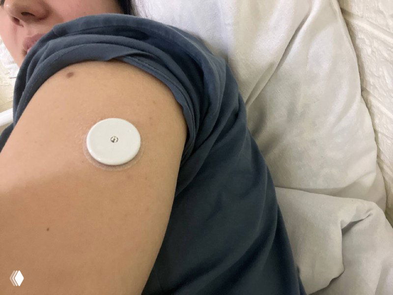 Близкий план руки с круглым датчиком непрерывного мониторинга глюкозы, прикреплённым на плечо — изображение демонстрирует использование сенсора во время беременности.