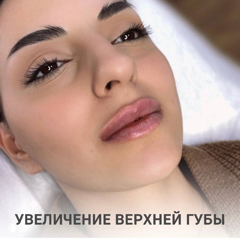 Контурная пластика: коррекция асимметрии губ