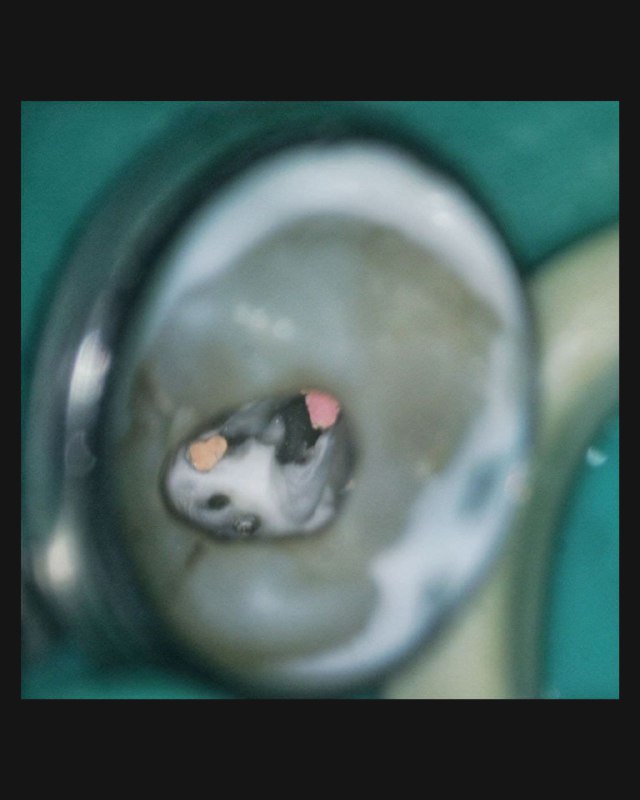 Крупный план операционного поля зуба при эндодонтическом доступе: видна полость, тёмное дно и светлые стенки, заметен маркер устья канала.