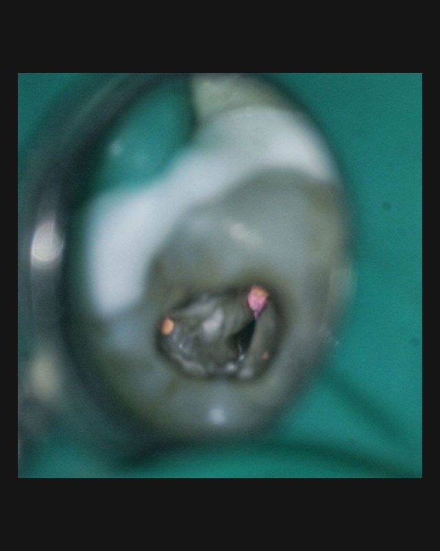 Операционный кадр с доступом к корневому каналу после удаления белого дентина: видна тёмная линия перешейка как ориентир устья.