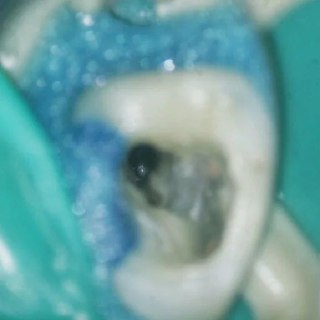 Крупный план рабочего поля: устье MB2 частично отходит из MB1, видны следы препарирования, коффердам и изолированное операционное поле.