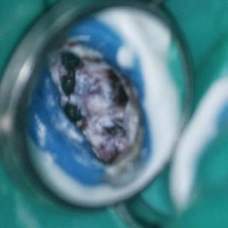 Клинический снимок под микроскопом: обнаружен неожиданный дополнительный канал MB3, демонстрирующий вариабельность корневой анатомии верхнего моляра.