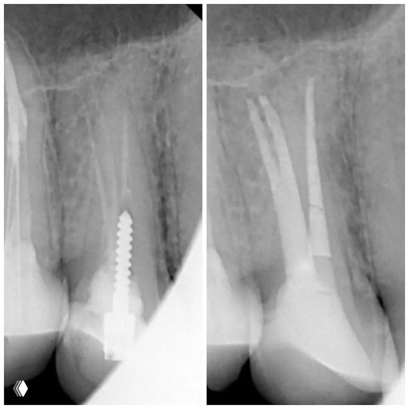 Моляризация премоляров — особенности анатомии