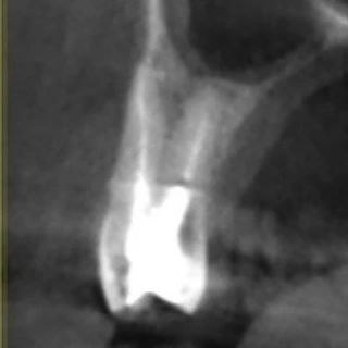 КТ/срез или боковой рентген премоляра, показывающий строение корней и плотность дентина вокруг щёчных каналов