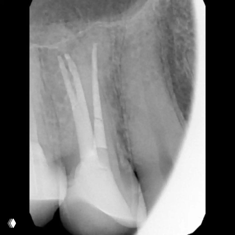 Контрольная рентгенограмма после обтурации каналов премоляра, видны три заполненных канала и адаптация пломбировочного материала