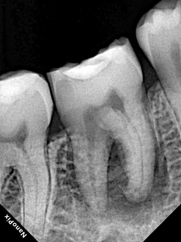 Аутотрансплантация: реколл через 6 месяцев