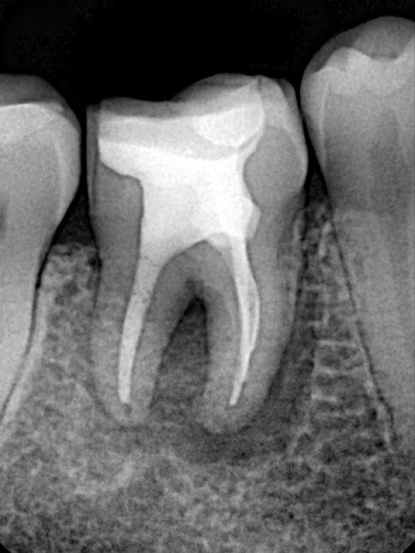 Контрольная рентгенограмма после обтурации вертикальной компакцией гуттаперчи — видна плотность обтурации и адаптация пломбы внутри каналов.