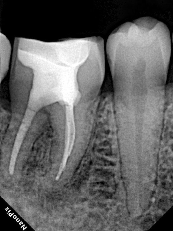 Финальный контрольный снимок: виден билдап и пломбирование коронковой части, оценка краевой адаптации реставрации и состояния окружающей кости.