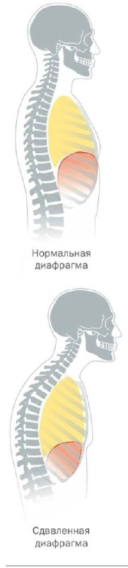 Схема диафрагмы в нормальном положении и при сжатии из-за кифоза: уменьшение объёма дыхания и поверхностное дыхание.