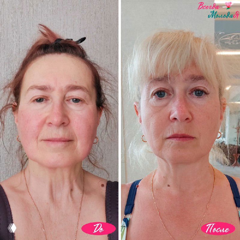 Естественное омоложение: результат курса и история Галины