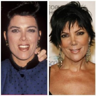 Почему у звёзд после подтяжки лицо кажется «как маска»?