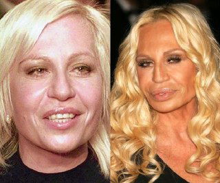 Коллаж из двух фотографий женского лица до и после процедур; заметны изменения губ, носогубных складок и общего рельефа лица после вмешательств