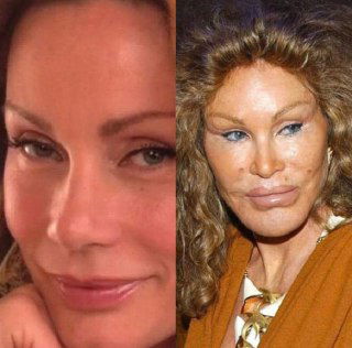 Сравнение профилей и лица женщины на двух снимках: видно усиленное контурирование, изменение объёма щёк и губ после эстетических процедур