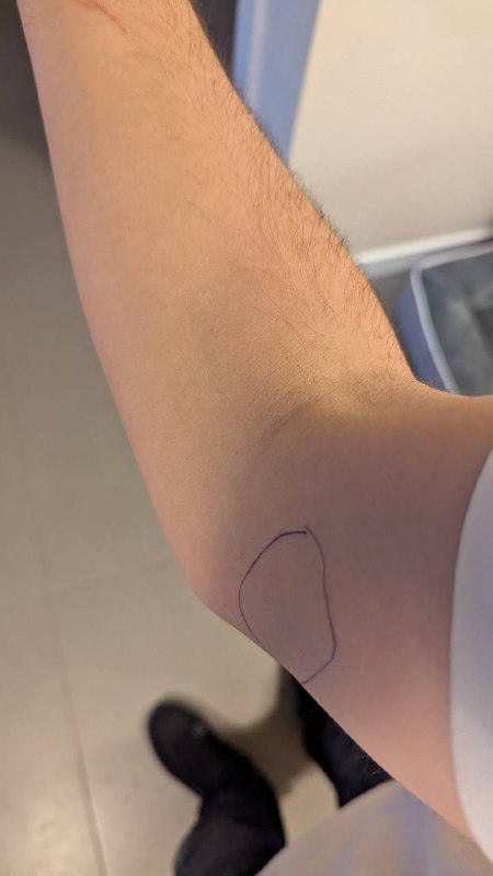 Фотография предплечья с круговой отметкой у локтевого сгиба, видно положение руки и точку боли, сделано для демонстрации ИИ.