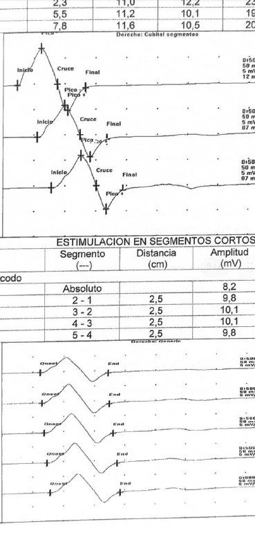 Отсканированная страница протокола электронейромиографии (ЭНМГ) с графиками и таблицами результатов исследования нервной проводимости руки.