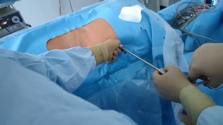 Операционная сцена: удлинённый эндоскопический тубус и руки хирурга при удалении грыжевого фрагмента через боковой доступ.