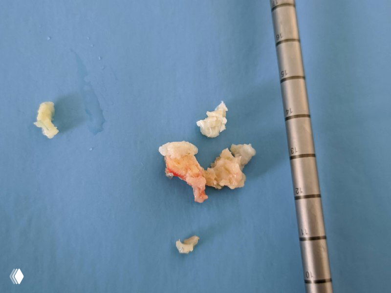 Эндоскопическое удаление грыжи межпозвонкового диска