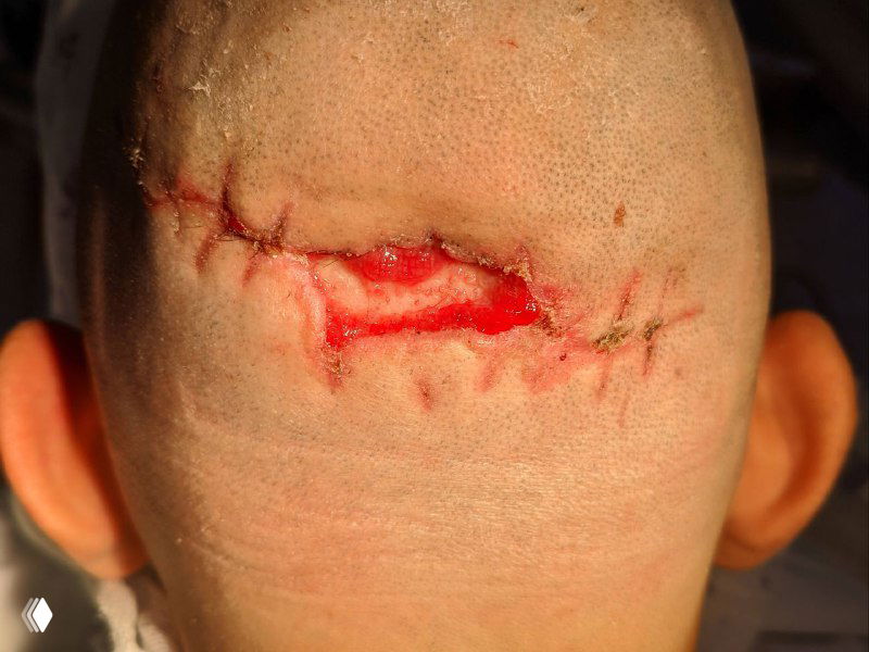 Ушибленные раны головы: результат ПХО и пластики