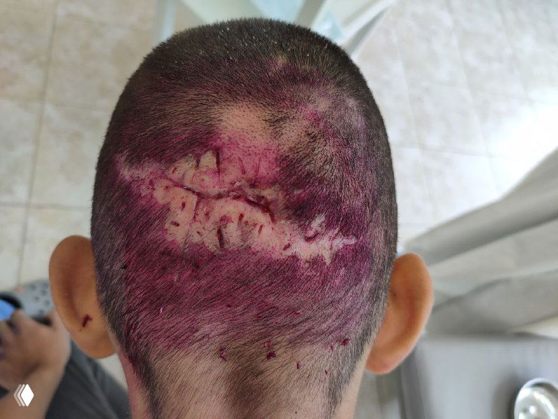 Затылок пациента после кожной пластики мягкими тканями: виден рубец, зона пересадки и обработанная поверхность с частично отросшими волосами.