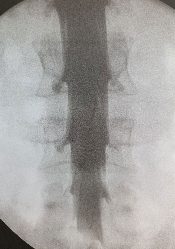 Миелография при подозрении на ликворную утечку