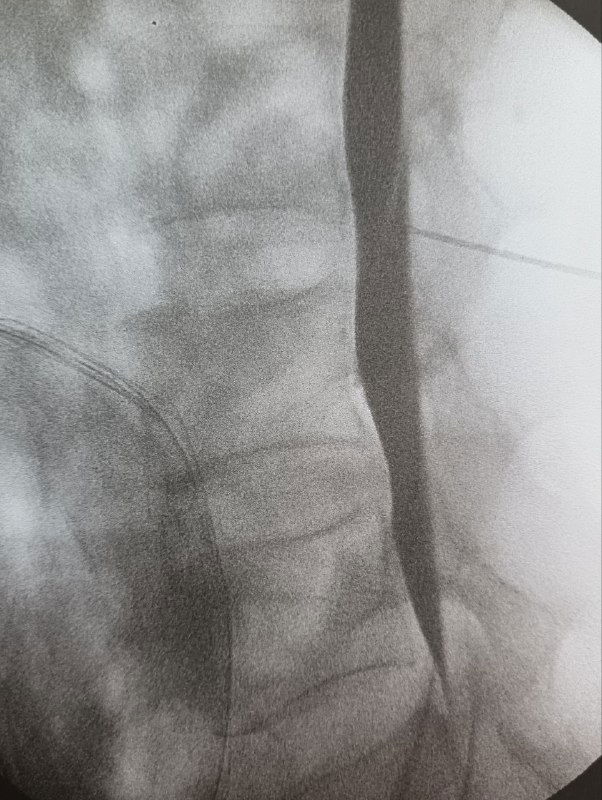 Рентгенологическое изображение шейного отдела с контрастным столбом при миелографии, оценка на предмет ликворной утечки.