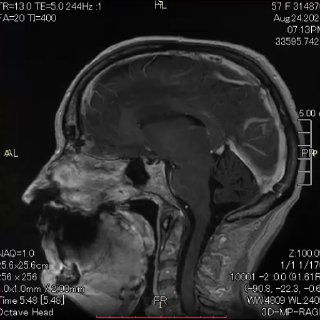 МРТ головного мозга в сагиттальной проекции: виден очаг опухолевого генеза и выраженный перифокальный отёк, клинический контекст — до/после операции.