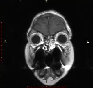 МРТ головного мозга в корональной проекции: визуализируется очаг в области лобно-височных отделов с окружающим отёком, иллюстрация клинического случая.