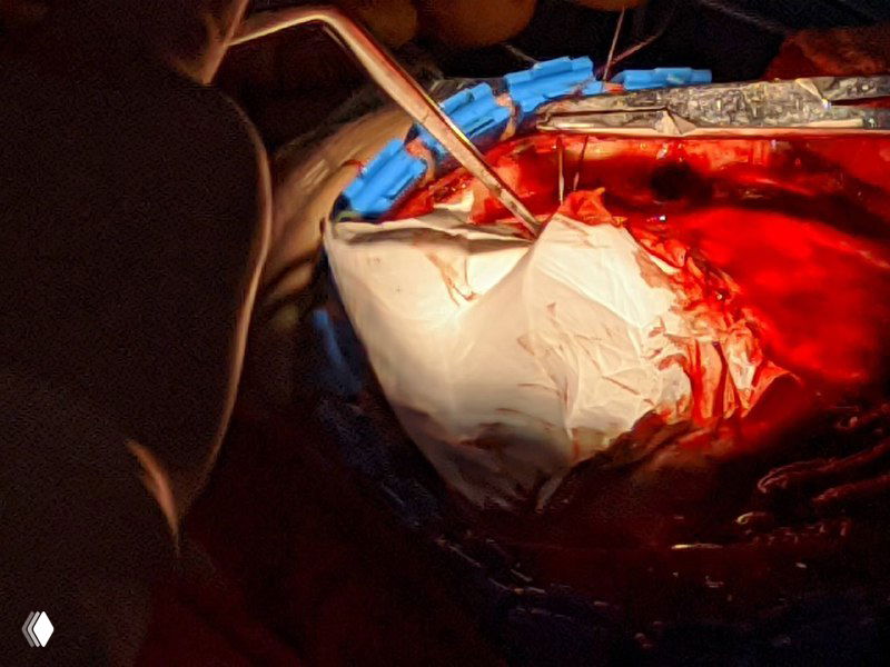 Искусственный протез при дефектах твёрдой мозговой оболочки