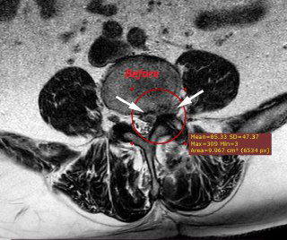 МРТ, аксиальная проекция поясничного отдела: окружность и стрелки показывают парамедианно‑фораминальную грыжу с экстрафораминальными элементами, видны аннотации и размеры.
