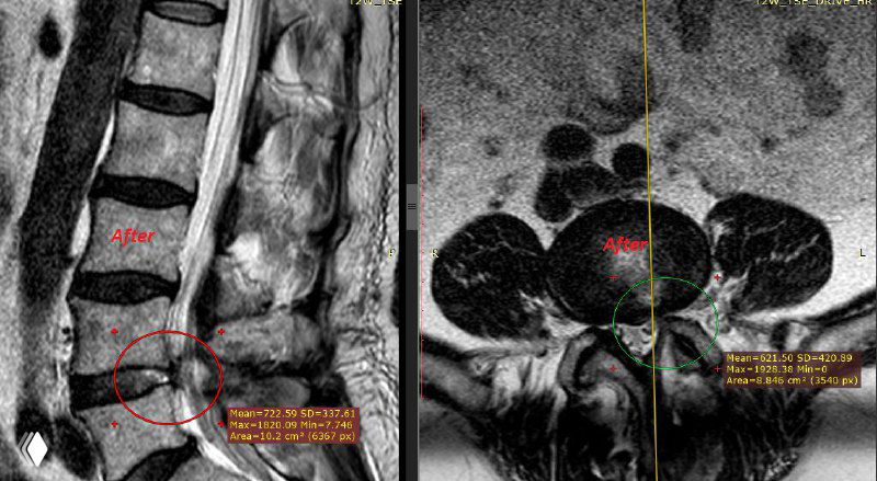 Компоновка МРТ до/после в двух проекциях: сравнительное изображение состояния диска с отмеченными зонами рецидива и служебными пометками для планирования доступа.