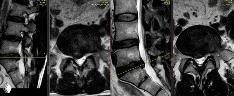 Лечение грыжи лазером