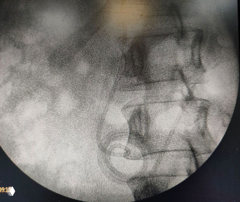 Петля в перитонеальной части шунта