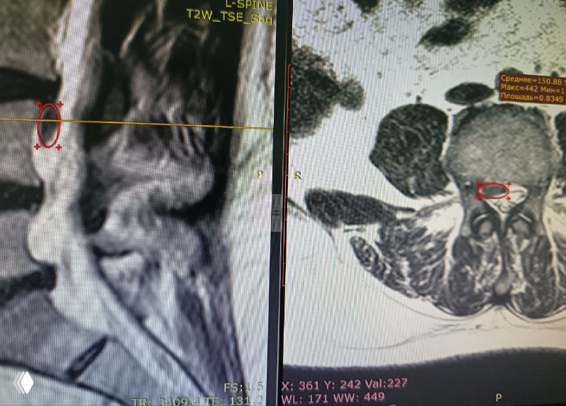 Почему 5 мм грыжа может давить на нерв