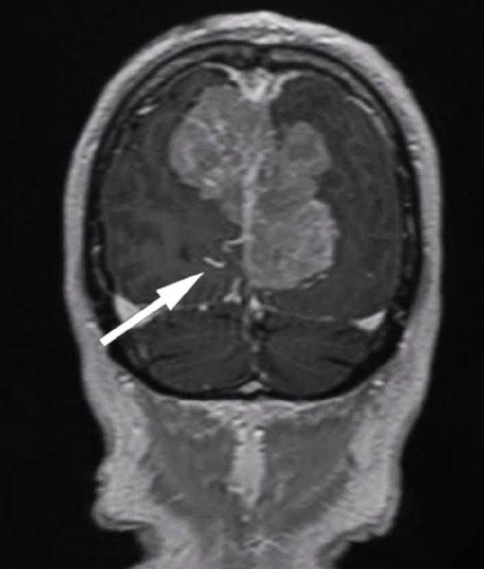 Менингиома затылочной области: случай и исход