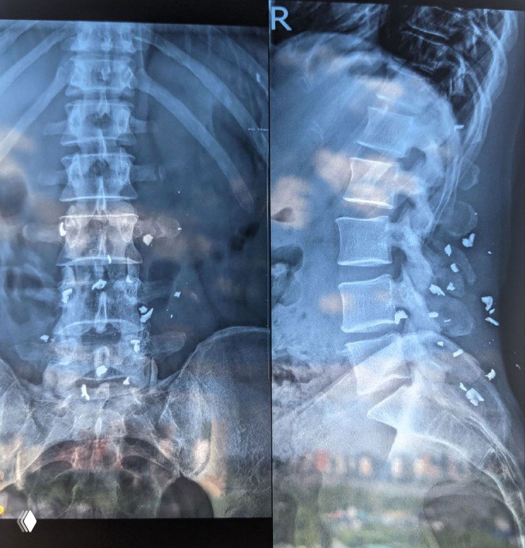 Удаление осколков, которые не угрожают жизни