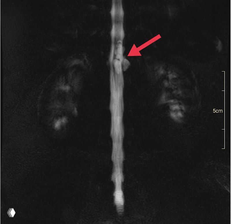 Эпидуральная киста после эпидуральных анестезий