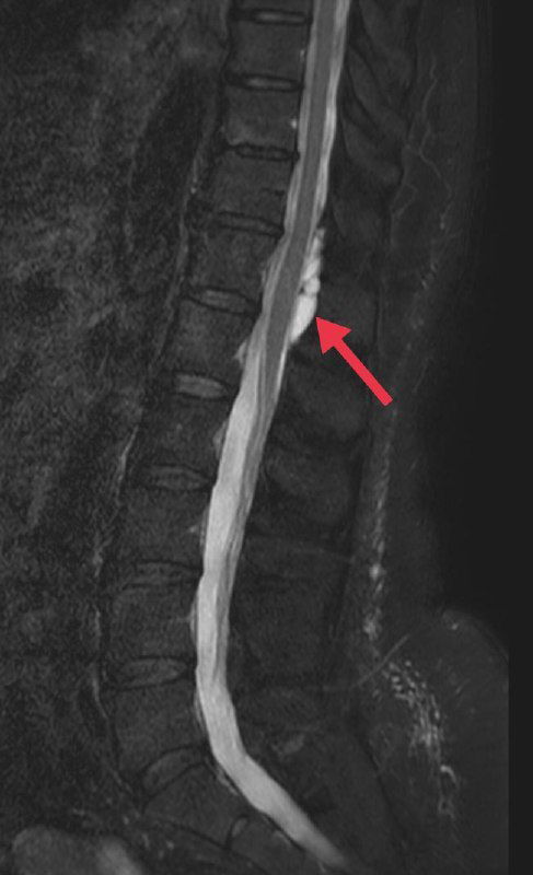 Сагиттальное МРТ поясничного отдела: стрелка указывает эпидуральную кисту с компрессией канала, связанной с нейропатической болью.