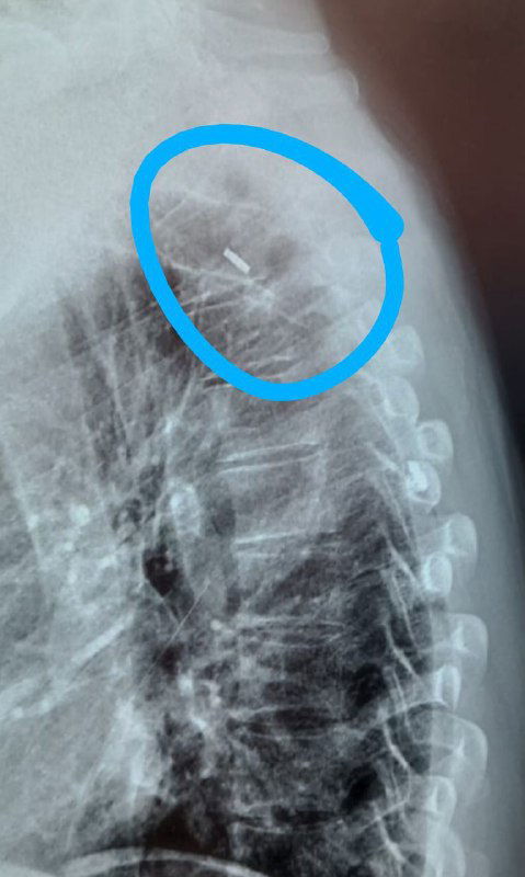 Эндоскопическое удаление металлического осколка из грудного отдела позвоночника