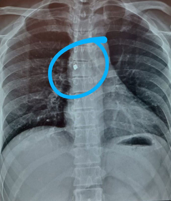 Передняя рентгенограмма грудной клетки: металлический осколок локализуется по средней линии на уровне грудного отдела позвоночника, обведён синим маркером.