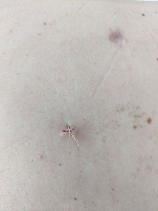 Фотография кожного входа после вмешательства в грудной области: небольшой заживающий разрез со швом и следами от пункции, видимая точка входа осколка.