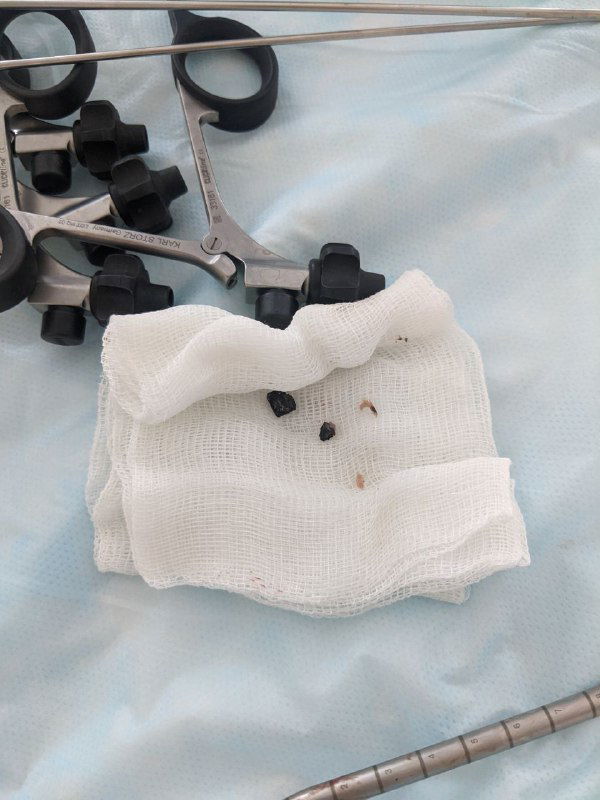 Операционные инструменты и извлечённые фрагменты металла на марле: несколько металлических осколков разного размера рядом с хирургическими щипцами.