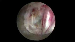 Кадр эндоскопа внутри позвоночного канала: видна поверхность ткани и удаляемый металлический фрагмент во время эндоскопической операции на грудном отделе.