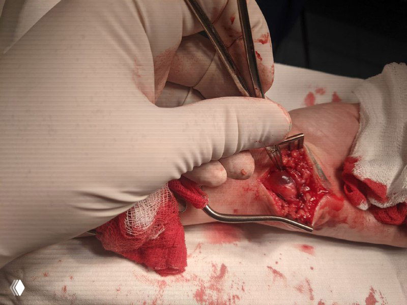 Крупная гигрома как причина сдавления локтевого нерва