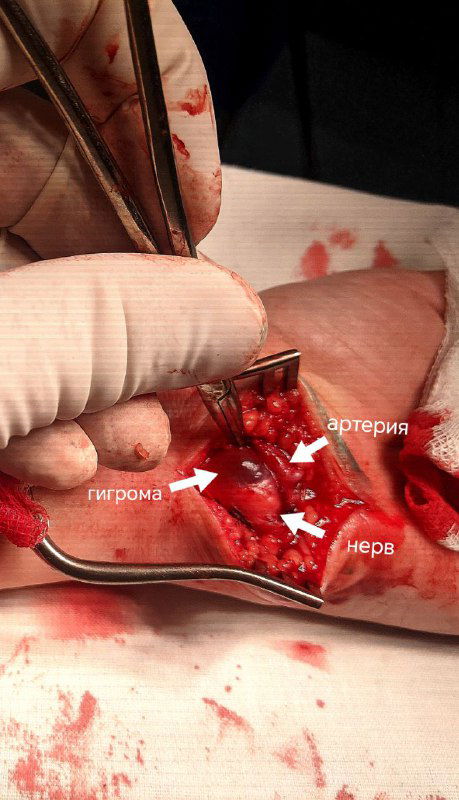 Детальное интраоперационное фото с указанием структур: гигрома, локтевой нерв и прилежащая артерия — демонстрация зоны сдавления в канале Гийона.
