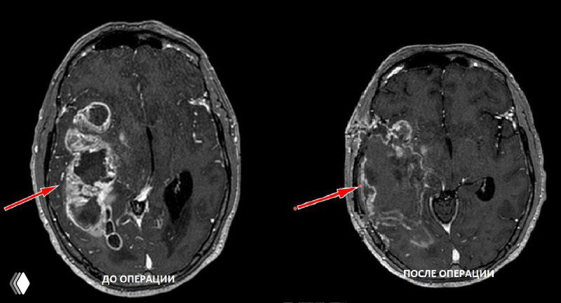 Глиобластома — злокачественная опухоль мозга