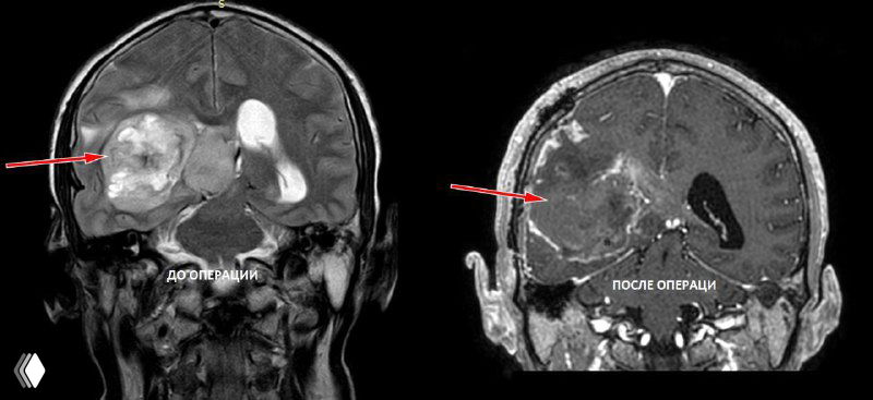 Коронарный и сагиттальный МРТ-обзор до/после операции: опухолевый объём в правом полушарии с интенсивным контрастированием и перифокальным отёком.